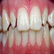 Teeth Whitening in Arverne, New York