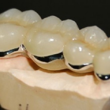 Dental Crown Supplier in Indianapolis, Indiana