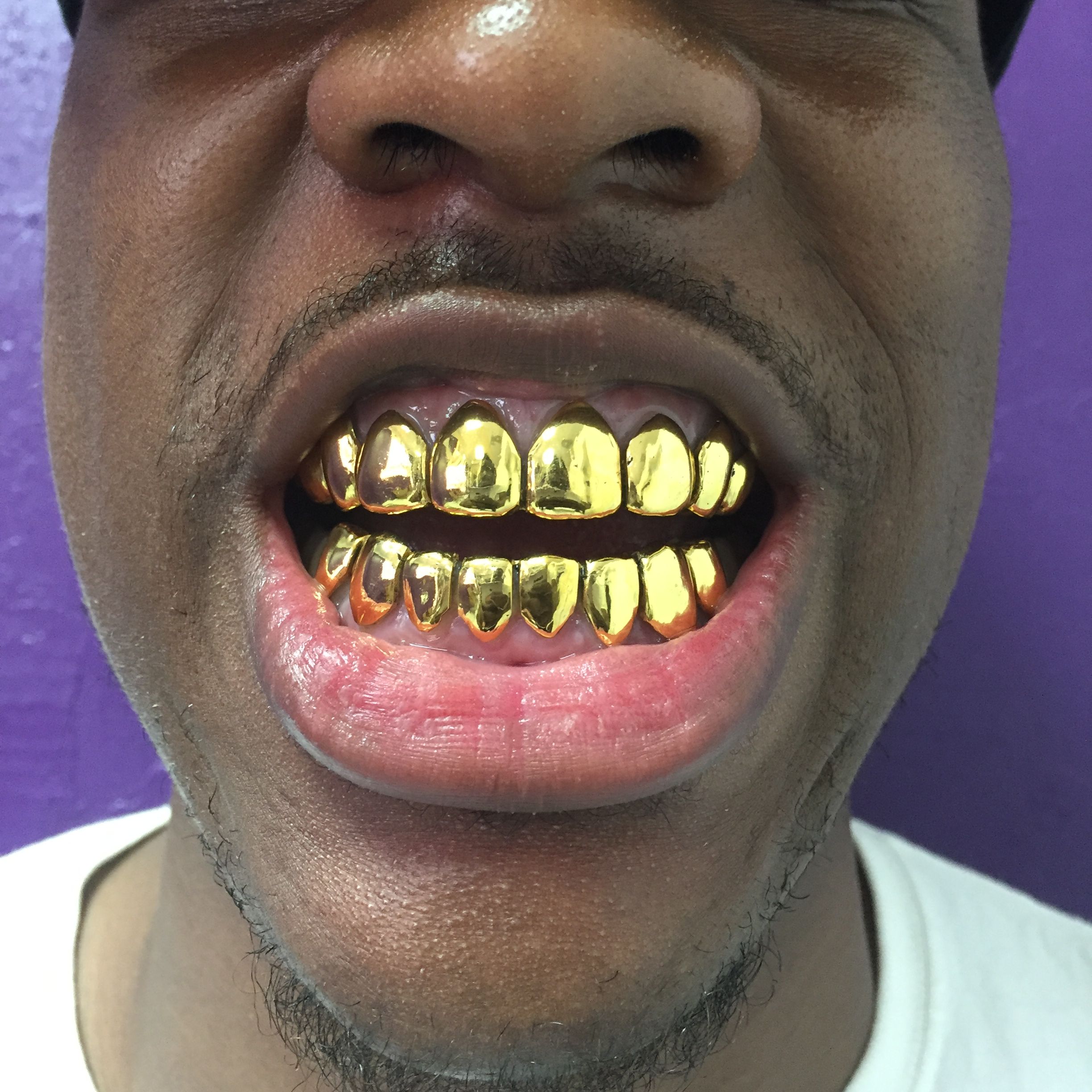 Gold Plated Mouth Piece in Lauderdale Lakes, Florida