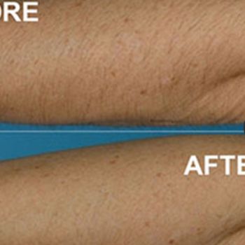 Stretch Mark Removal in North Little Rock, Arkansas