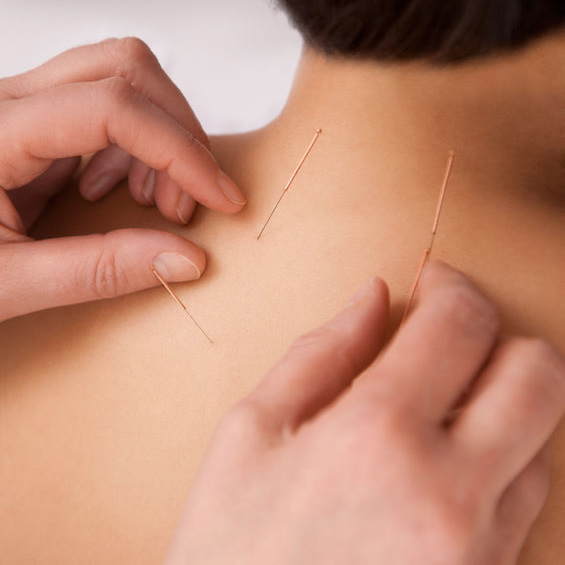Acupuncture Therapy in Glenwood Springs, Colorado