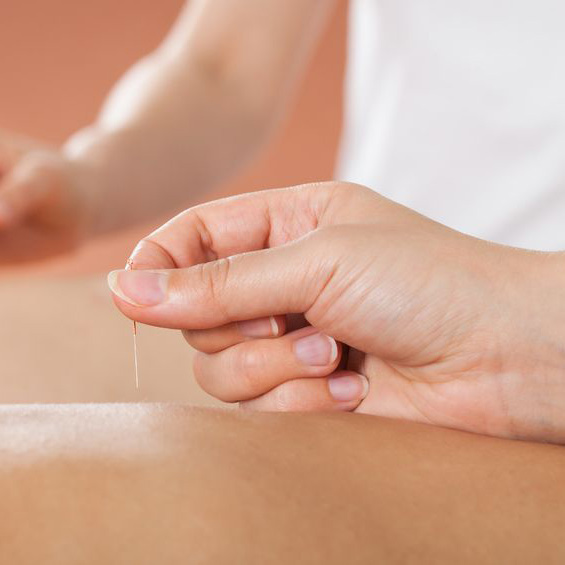 Acupuncture in Glenwood Springs, Colorado